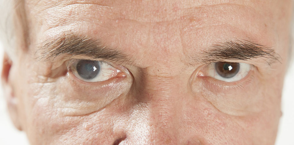 Catarata é a opacidade da lente natural do olho